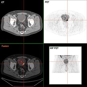 Blasenkrebs in der FDG-PET/CT-Darstellung. Credits: Wikipedia/Gemeinfrei