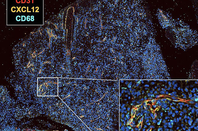 Dargestellt ist ein Gewebsstück eines Glioblastoms. Die Gefäße sind rot, der Botenstoff CXCL12 gelb gefärbt. Die Darstellung zeigt, dass der Botenstoff um Gefäße herum gebildet wird. | Copyright: Universitätsklinikum Bonn 