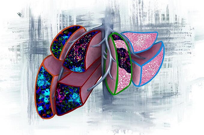 Das Bild illustriert vier prognostische Szenarien, die in Leberbiopsien gefunden werden können, wenn Bauchspeicheldrüsenkrebs vor der Metastasierung diagnostiziert wird. (Von links nach rechts) Orange: NETs die auf Lebermetastasen in weniger als 6 Monaten hindeuten. Rot: NETs und T-Zellen, die auf eine Lebermetastasierung in mehr als 6 Monaten hindeuten. Grün: T-Zellen und Fettleber, was auf eine Metastasierung in ein anderes Organ hindeutet. Blau: Normale Leber mit Fettleber, die keine Anzeichen für eine zukünftige Metastasierung erkennen lässt. Credits: Vanessa Dudley