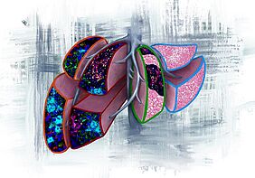 Das Bild illustriert vier prognostische Szenarien, die in Leberbiopsien gefunden werden können, wenn Bauchspeicheldrüsenkrebs vor der Metastasierung diagnostiziert wird. (Von links nach rechts) Orange: NETs die auf Lebermetastasen in weniger als 6 Monaten hindeuten. Rot: NETs und T-Zellen, die auf eine Lebermetastasierung in mehr als 6 Monaten hindeuten. Grün: T-Zellen und Fettleber, was auf eine Metastasierung in ein anderes Organ hindeutet. Blau: Normale Leber mit Fettleber, die keine Anzeichen für eine zukünftige Metastasierung erkennen lässt. Credits: Vanessa Dudley